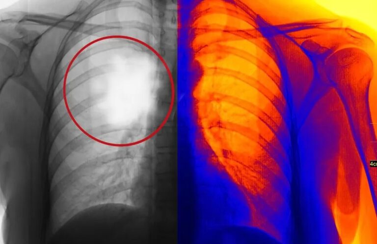 Pluća nemaju receptore za bol. Tumor unutar ovog organa može da raste, a da osoba ne osjeti apsolutno ništa